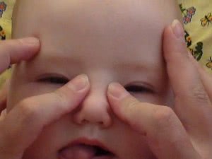 Дакриоцистит новорожденных: массаж, лечение, видео
