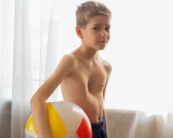 Деформация грудной клетки у детей. Лечение воронкообразной и килевидной деформации грудной клетки