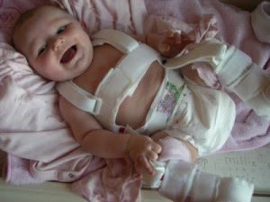 Дисплазия тазобедренного сустава (врожденный вывих бедра) у детей: причины, гимнастика, методы диагностики и лечение