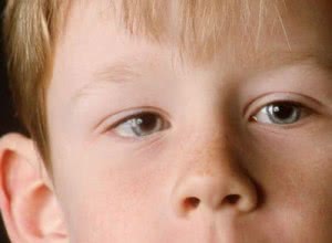 Косоглазие у детей: причины и лечение косоглазия
