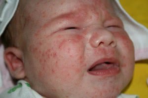 Прыщи на лице у новорожденных: причины, лечение, профилактика