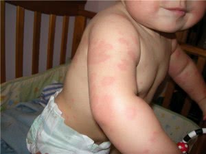 Сыпь на теле у ребенка: основные признаки, фото и методы лечения