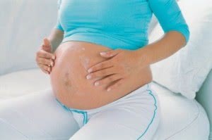 Стрии при беременности: основные причины. Можно ли избежать растяжения кожи?