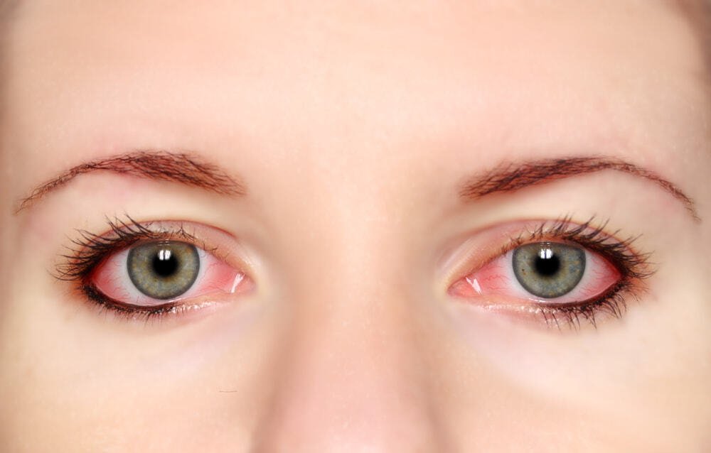Аллергия на глазах: причины, симптомы, как выглядит, чем лечить