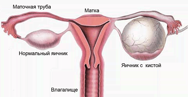 Апоплексия яичника — что нужно знать?