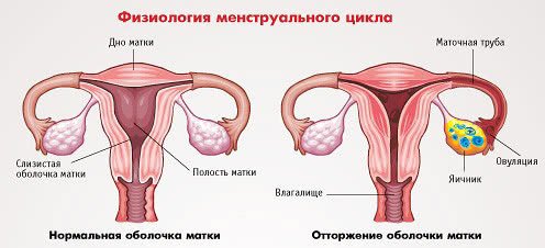 Что такое аменорея?