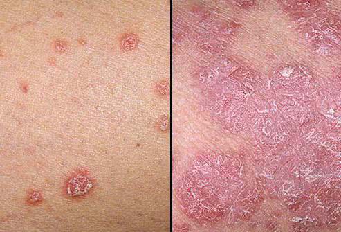 Доброкачественные опухоли кожи лечение и симптомы