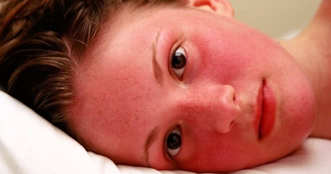 Эритремия – чем может быть опасно красное лицо?