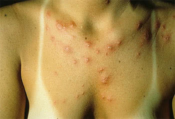 Фотодерматоз (аллергия на солнце): симптомы и лечение