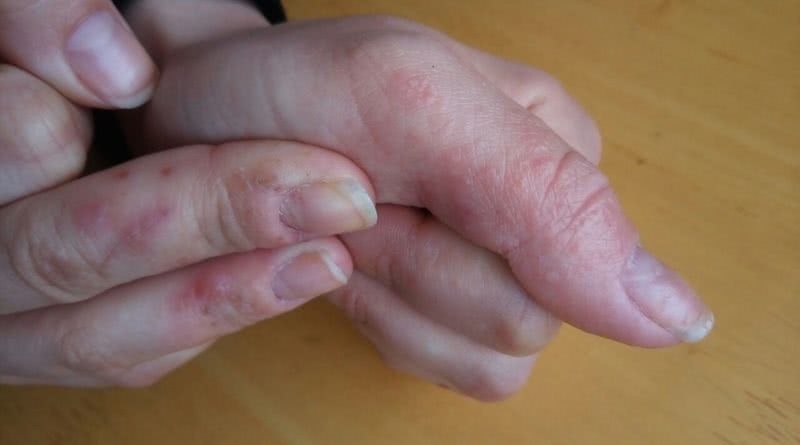 Главные причины и лучшие методы лечения трещин на пальцах рук