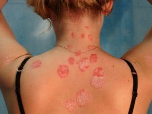 Инфекционный лишай: почему опасно лечить кожу самому