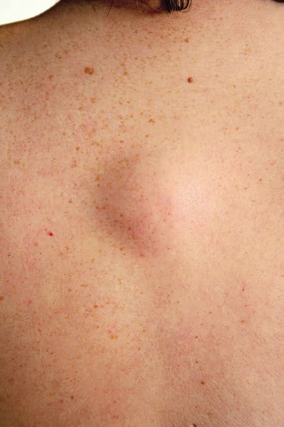 Не только кожа: 5 участков тела, где меланома развивается чаще всего