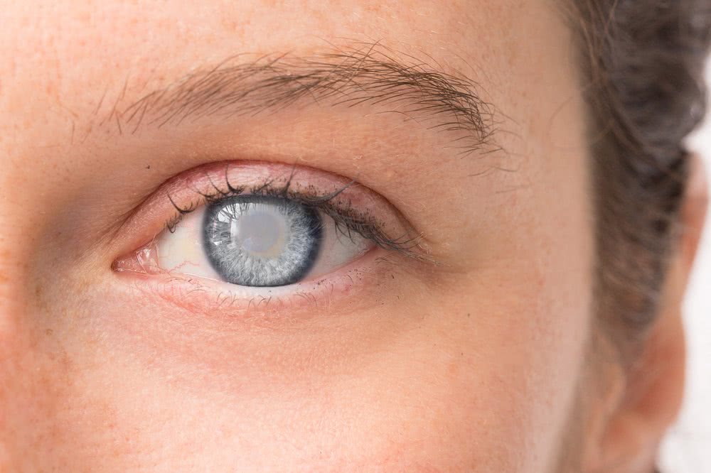 Патология глаза: как выглядит катаракта?