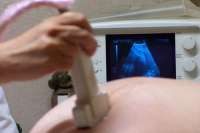 Предложен более достоверный маркер риска преждевременных родов вместо длины шейки