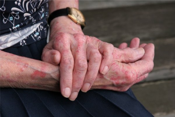 Псориаз на руках: как выявить и лечить заболевание