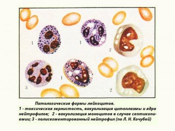 Патологические формы лейкоцитов