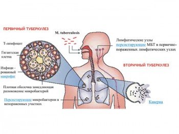 Первичный и вторичный туберкулез