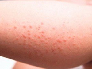 Противопоказание мази Никофлекс при аллергии на компоненты
