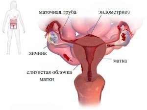 Схема эндометриоза