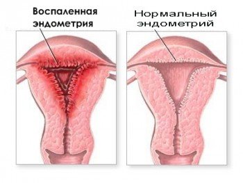 Схема эндометрита