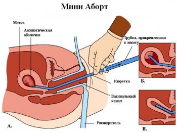 Мини-аборт