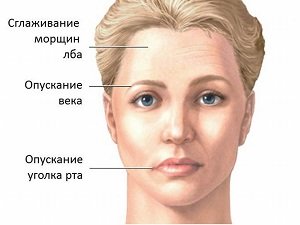 Признаки неврита лицевого нерва