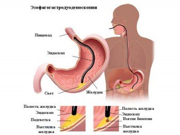 Проведение эндоскопии желудка