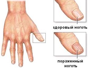 Псориаз ногтей