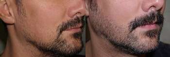 Результат применения миноксидила на бороде