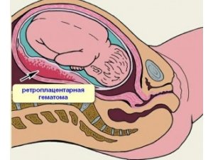 Фраксипарин при угрозе невынашивания беременности
