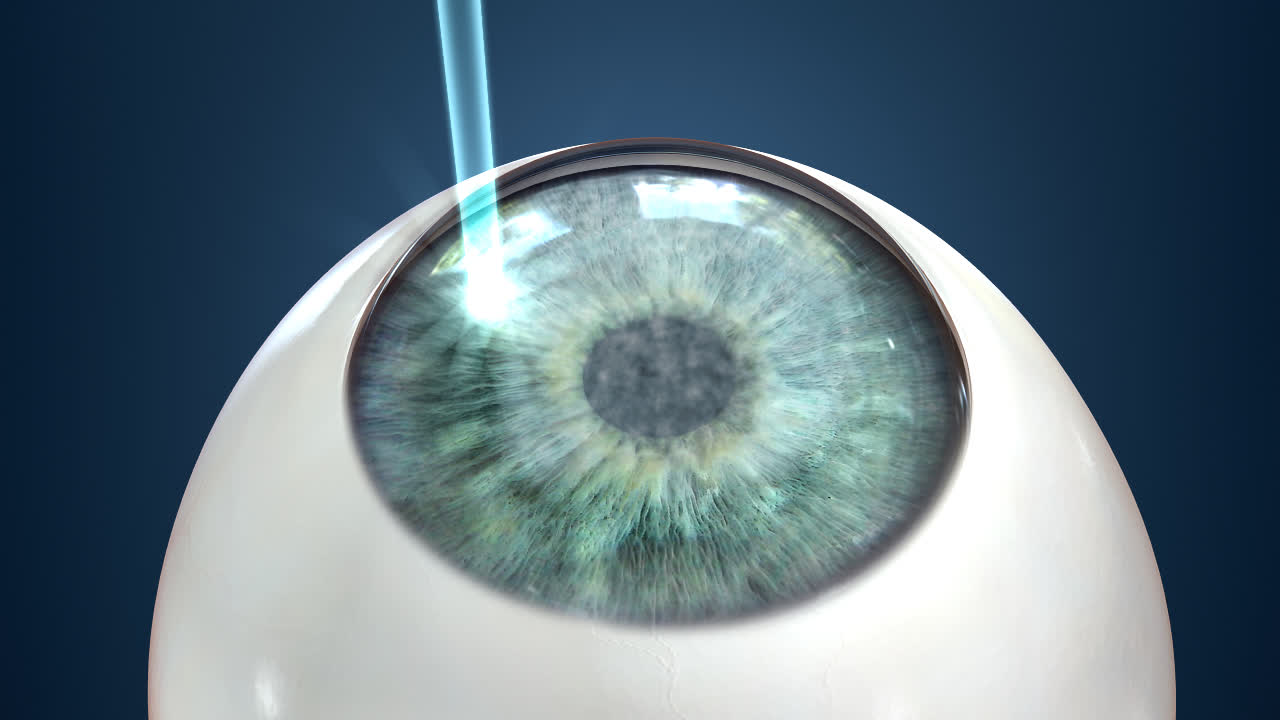 Зрение 2 операция