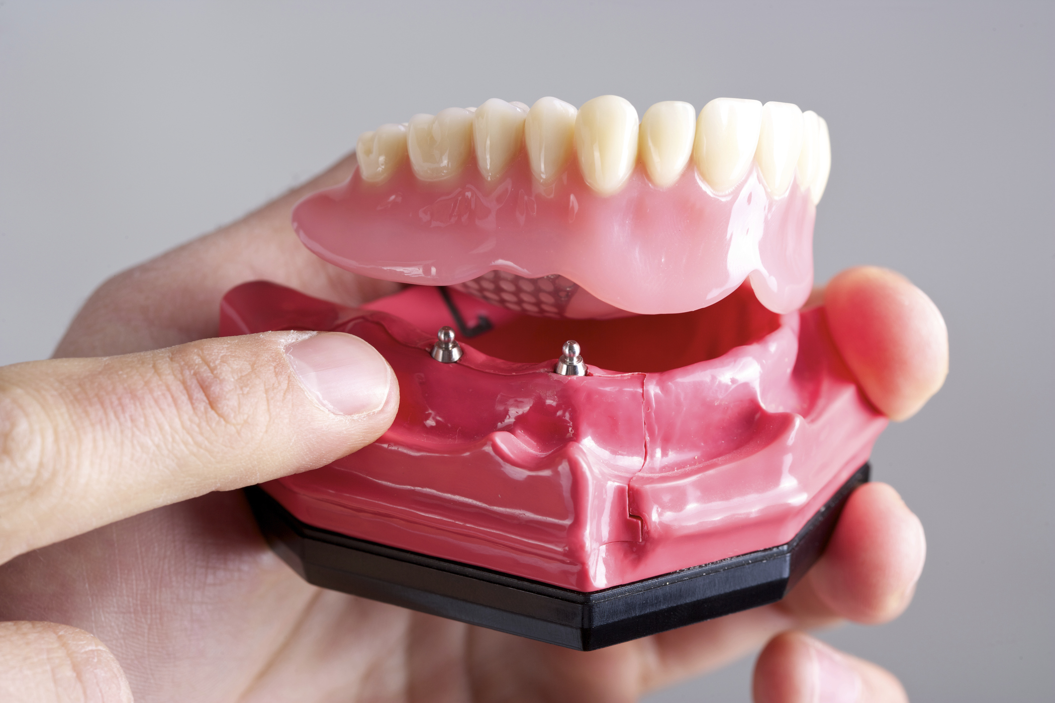 Какие зубные протезы лучше при отсутствии зубов. Полный съемный пластиночный протез на имплантах. Условно съемный протез на имплантатах. Условно съемный протез на 4 имплантатах. Полный съемный ПРОТЕХ на 4 имплантах.