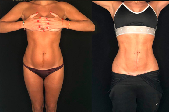 фото до и после липомоделирования тела